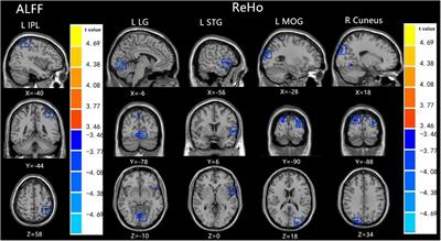 Brain Functional Alterations in Prepubertal Boys With Autism Spectrum Disorders